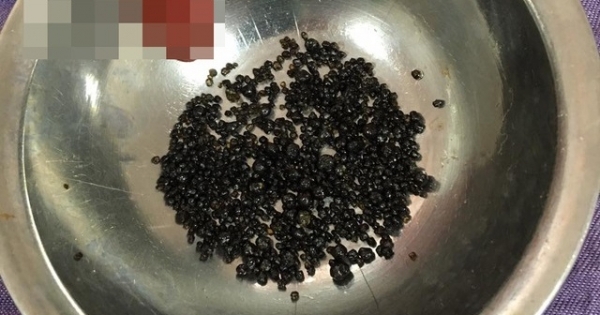 Giật mình với hàng trăm viên sỏi trong túi mật của một nữ bệnh nhân 50 tuổi