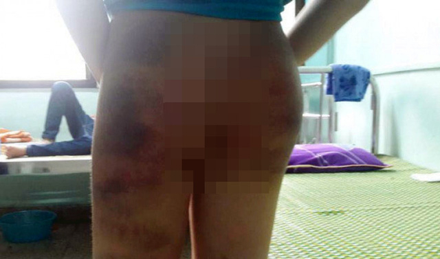 Những vết bầm t&iacute;m tr&ecirc;n cơ thể ch&aacute;u H. N. (Ảnh: b&aacute;o D&acirc;n tr&iacute;)
