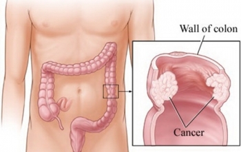 Những dấu hiệu nhận biết ung thư đại trực tràng