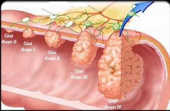 Bất ngờ với những nguyên nhân gây ung thư đại trực tràng