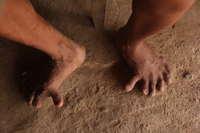 Bị dị tật n&ecirc;n những th&agrave;nh vi&ecirc;n trong gia đ&igrave;nh anh Hồ Cao đều kh&ocirc;ng thể đi gi&agrave;y, d&eacute;p