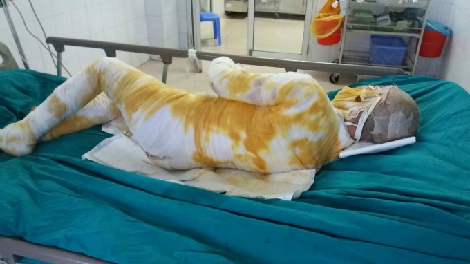 Một trong hai c&ocirc; g&aacute;i bị thi&ecirc;u sống đ&atilde; tử vong.