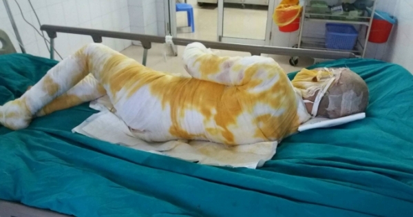 Cô gái trẻ bị bạn trai thiêu sống do ghen tuông ở Vĩnh Phúc đã tử vong