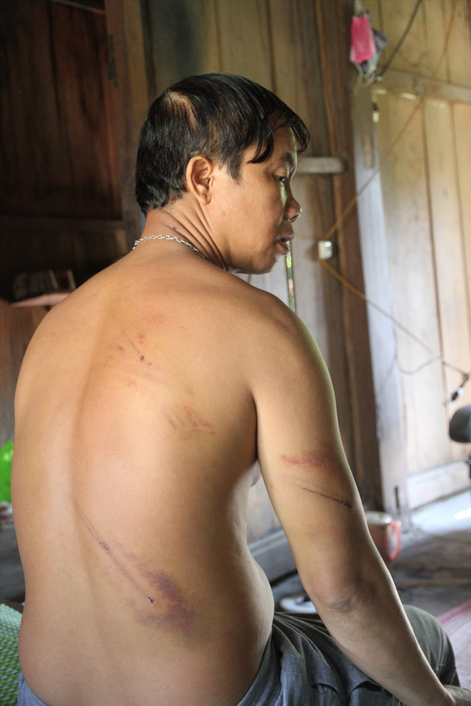 Những vết bầm t&iacute;m tr&ecirc;n người anh Hồ Văn Đan do bị bảo vệ mỏ v&agrave;ng đ&aacute;nh đập