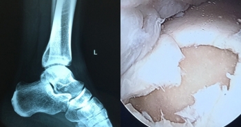 Các quý ông hay đá bóng đặc biệt lưu ý điều này nếu không muốn chân bị tật