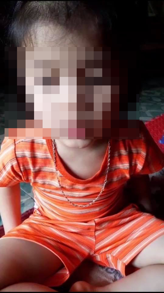 B&eacute; Ho&agrave;ng Nguyễn B.Y. (5 tuổi) nghi bị c&ocirc; gi&aacute;o b&ocirc;i chất bẩn v&agrave;o v&ugrave;ng k&iacute;n dẫn&nbsp;đến vi&ecirc;m&nbsp;&acirc;m&nbsp;đạo.