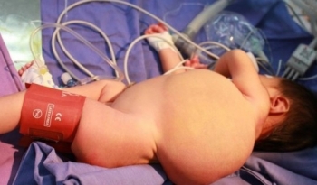 Phẫu thuật khối u bạch huyết khổng lồ cho bé trai 20 tháng tuổi