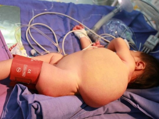 Bệnh u bạch huyết&nbsp;&nbsp;90% xảy ra ở trẻ em dưới 2 tuổi v&agrave; hay gặp ở v&ugrave;ng đầu, cổ.   &nbsp;Ảnh minh hoạ: Internet.