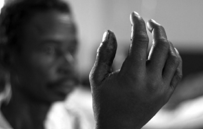 Một người d&acirc;n chịu cảnh tật nguyền v&igrave; bịrắn cắn.