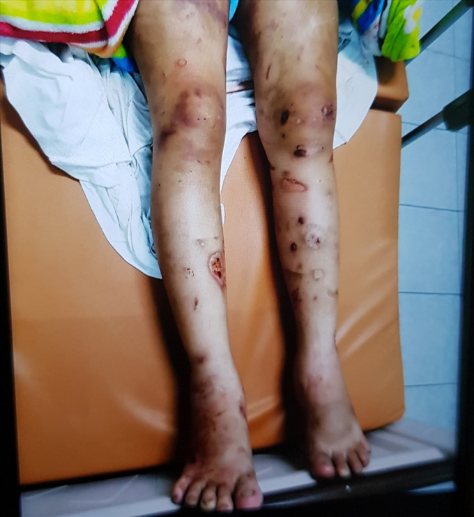 Nạn nh&acirc;n Y với chi ch&iacute;t những vết thương khắp cơ thể khi nhập viện. Ảnh: T.S