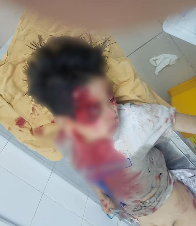 B&eacute; trai bị thương nặng.