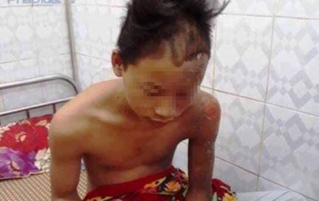 Bị sét đánh trúng đầu, nam sinh thoát chết trong gang tấc