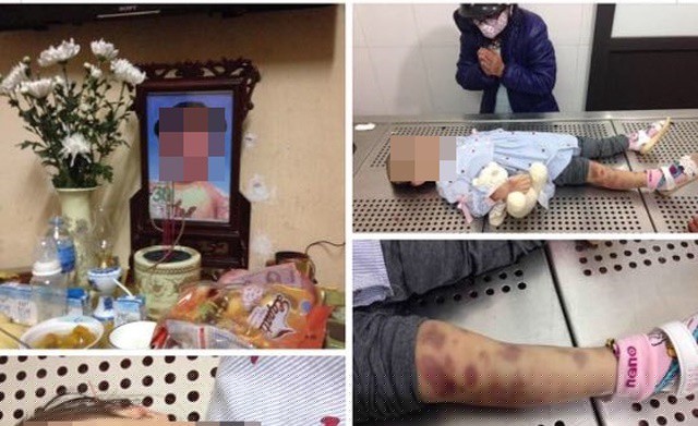 Bé N.N.M.M (3 tuổi) tử vong với nhiều vết thâm tím.