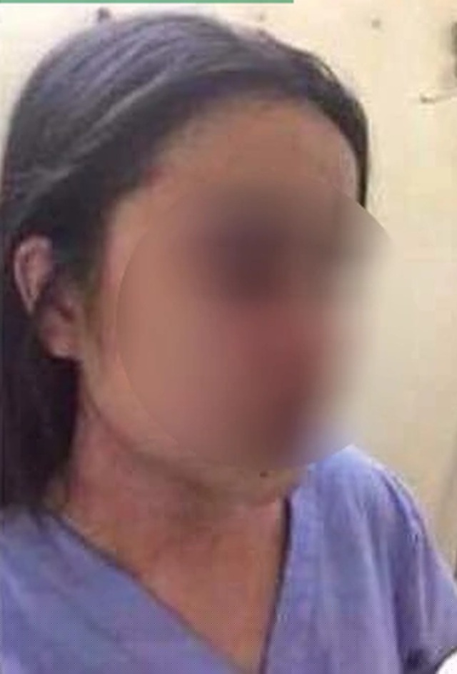Nhiều thương tích trên mặt chị T. do bị bác sĩ Phương đánh