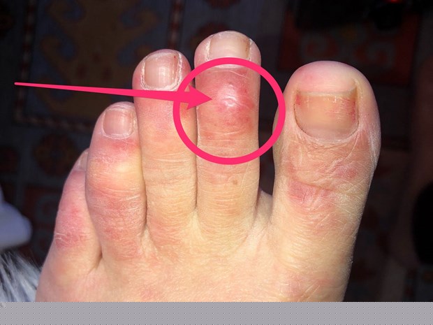 Bệnh nhân COVID-19 bị sưng ngón chân. (Ảnh: Business Insider)