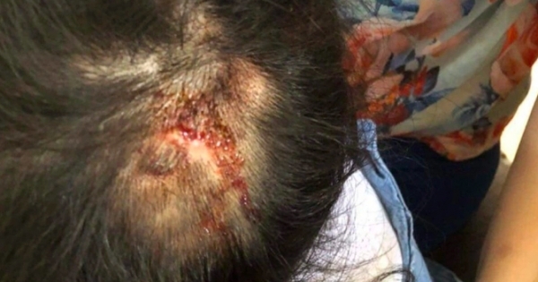 Thông tin mới vụ dì ruột đánh cháu 4 tuổi bầm tím khắp người ở Hà Tĩnh