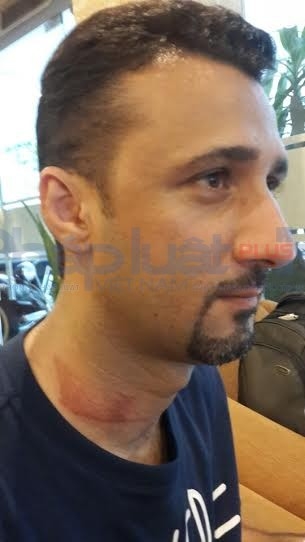 Do đeo t&uacute;i ch&eacute;o n&ecirc;n sau khi bị giật, cổ của &ocirc;ng Mohammad hằn r&otilde; vệt bầm.