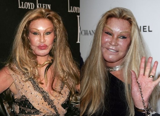 Jocelyn Wildenstein từng l&agrave; mỹ nh&acirc;n của l&agrave;ng giải tr&iacute; thế giới những năm 1970. Tuy nhi&ecirc;n sau khi quyết định phẫu thuật thẩm mỹ để gi&agrave;nh lại chồng từ tay t&igrave;nh địch th&igrave; nhan sắc của c&ocirc; đ&atilde; trở th&agrave;nh thảm họa.&nbsp;