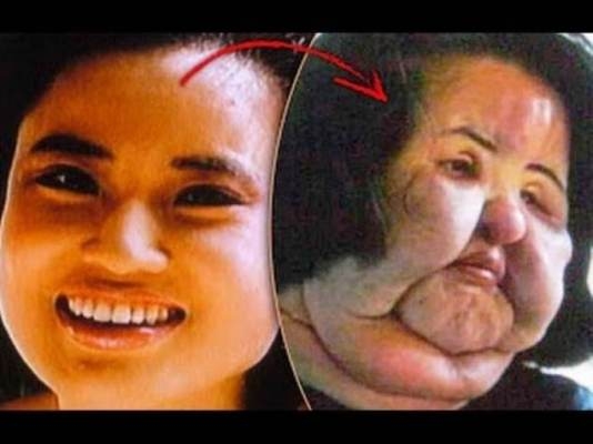 Hang Mioku - một người mẫu tiềm năng của H&agrave;n Quốc đ&atilde; tự hủy hoại nhan sắc của m&igrave;nh khi c&ocirc; quyết định bơm dầu v&agrave;o mặt ở một bệnh viện tư.