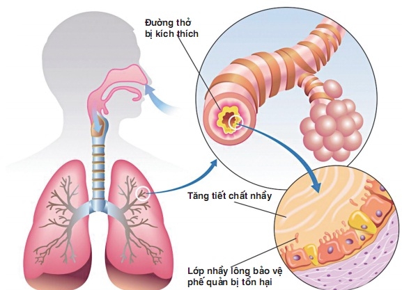 Biến chứng do vi&ecirc;m phế quản mạn t&iacute;nh