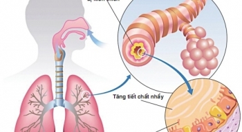 Biến chứng do viêm phế quản mạn tính