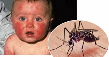 WHO cánh cáo dịch virus Zika vẫn tiếp tục lan mạnh trong mùa hè tới