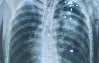 Hy hữu, 20 viên đạn găm vào người vẫn thoát chết