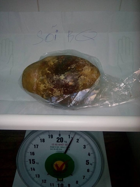 H&igrave;nh ảnh vi&ecirc;n sỏi b&agrave;ng quang được lấy ra từ người bệnh nh&acirc;n. (C&ocirc;ng An Nh&acirc;n D&acirc;n)