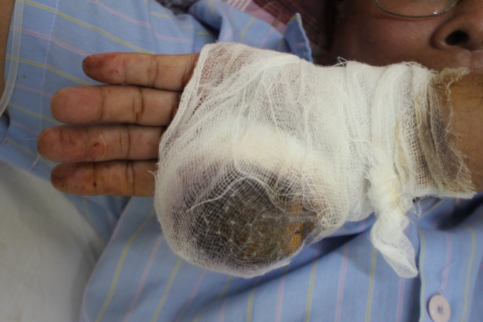 Ng&oacute;n tay c&aacute;i b&agrave;n tay tr&aacute;i của &ocirc;ng Lộc bị ch&eacute;m đứt l&igrave;a.