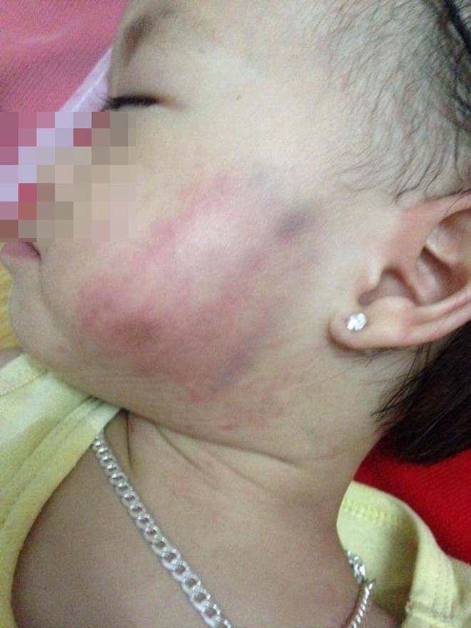 Ch&aacute;u P. nghi bị c&ocirc; gi&aacute;o đ&aacute;nh bầm t&igrave;m mặt. Ảnh: Internet