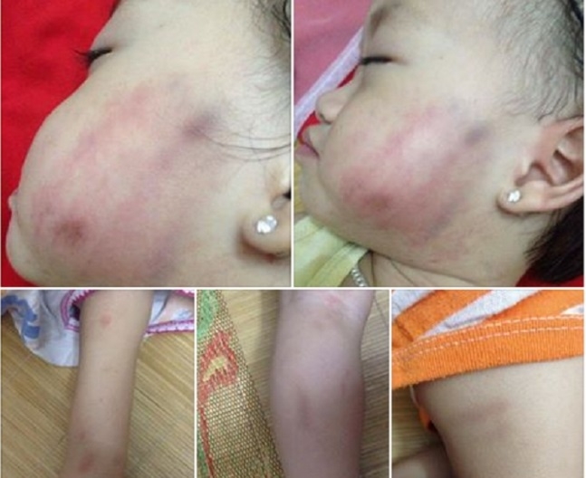 Ch&aacute;u b&eacute; 16 th&aacute;ng tuổi bị c&ocirc; gi&aacute;o đ&aacute;nh bầm t&iacute;m cơ thể chiều ng&agrave;y 26/5. (ảnh: FB)