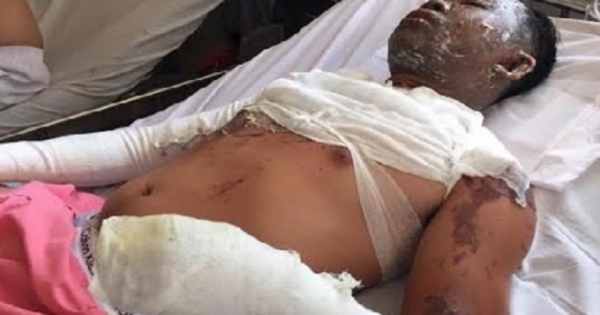 Tiền Giang: Bị vợ tạt dầu sôi vào người