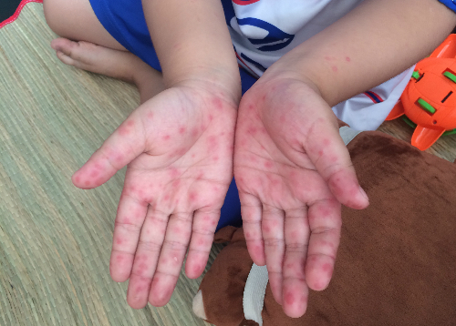 Trẻ bị tay ch&acirc;n miệng. Ảnh:&nbsp;L&ecirc; Phương.