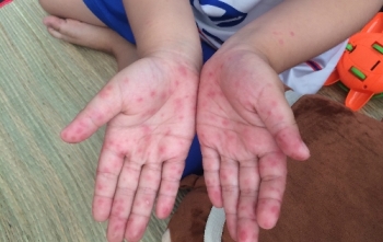 Chủ động phòng bệnh mùa nắng nóng