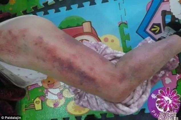 Những vết bầm do 'vỗ, đập' tr&ecirc;n người ch&aacute;u b&eacute;.