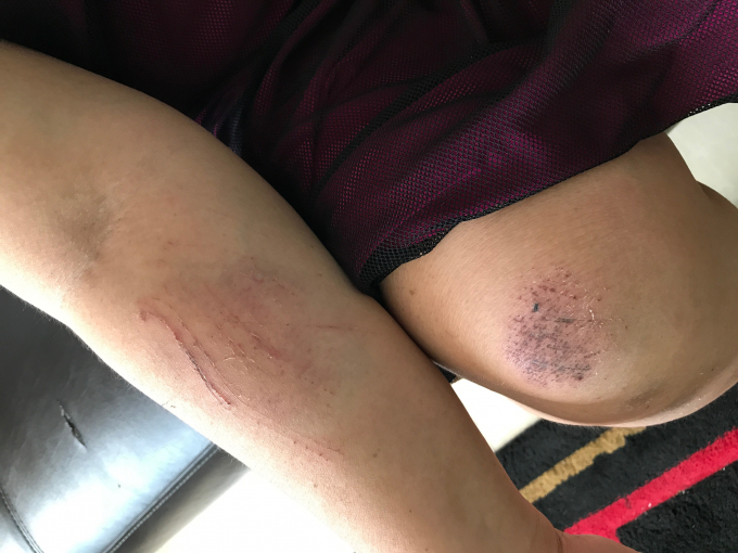 B&agrave; Liễu bị nh&oacute;m đối tượng lạ mặt x&ocirc;ng v&agrave;o nh&agrave; đ&aacute;nh đập, g&acirc;y th&acirc;m tim v&agrave; x&acirc;y xước nhiều nơi.