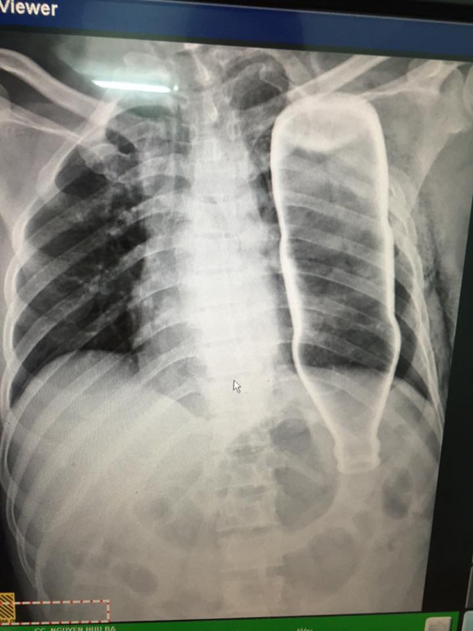 Chai thủy tinh nằm gọn trong lồng ngực của &ocirc;ng B.