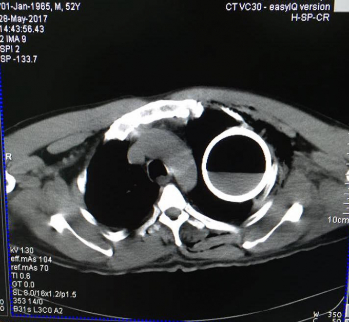 Dị vật chui v&agrave;o ngực &ocirc;ng B. khi nạn nh&acirc;n ng&atilde; từ cầu thang xuống đất.