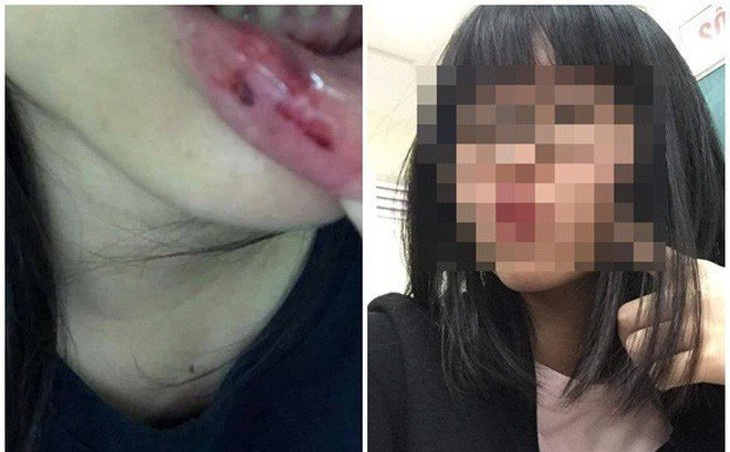 H&igrave;nh ảnh T.D tố bị anh rể đ&aacute;nh.