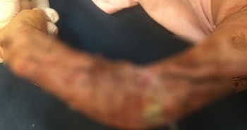 Chập chững ra đường, bé trai 19 tháng tuổi bị xe tải tông dập nát cánh tay