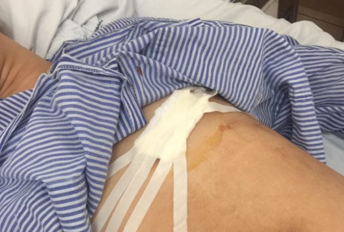 Anh S. bị đâm vào vùng ngực trái gây nguy hiểm đến tính mạng.