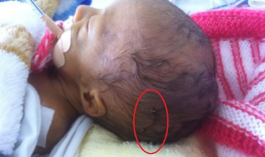 Con anh Ph&uacute;c với vết kh&acirc;u tr&ecirc;n đầu.