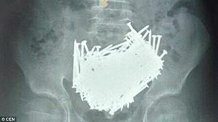 H&igrave;nh ảnh chụp CT ph&aacute;t hiện những chiếc đinh trong bụng cậu b&eacute;. (Ảnh: Tiền Phong)