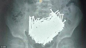 Mắc hội chứng dị thực: Cậu bé nuốt 200 cái đinh vào bụng trong một tháng