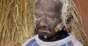 Cậu bé đáng thương với làn da bị hóa đá