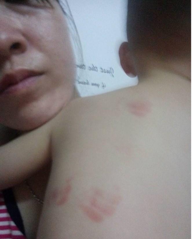 H&igrave;nh ảnh những vết bầm t&iacute;m tr&ecirc;n lưng b&eacute; trai 20 th&aacute;ng tuổi. (Ảnh: Infonet)