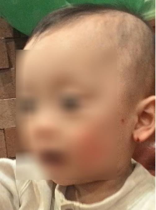 B&eacute; trai bị cắn t&iacute;m lưng ở trường mầm non. (Ảnh: Người đưa tin)