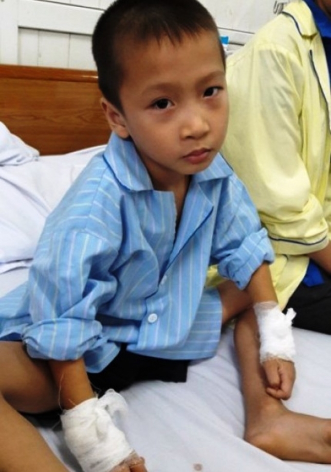 H&igrave;nh ảnh hai tay b&eacute; Lu&acirc;n đều bị băng b&oacute;. (Ảnh: D&acirc;n tr&iacute;)