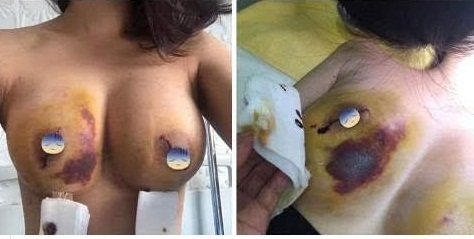 Bản tin Pháp luật: "Tai nạn" trong phẫu thuật thẩm mỹ, ai chịu trách nhiệm?