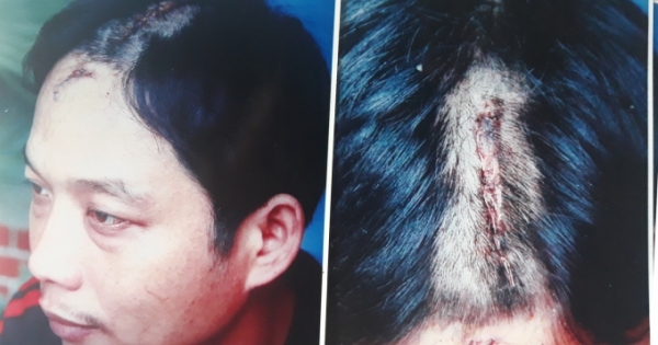 Nghệ An: Chém người tổn hại 12% sức khỏe, sao chưa khởi tố?